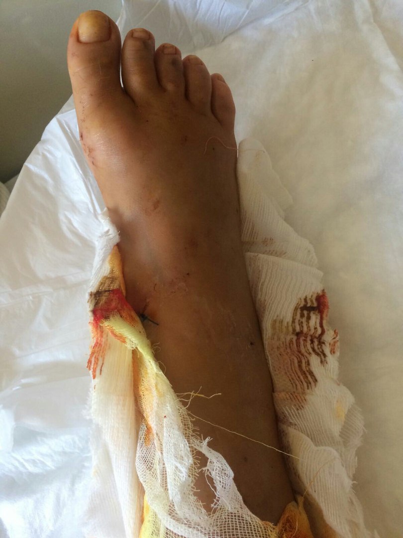 Екатеринбурженка, едва не лишившаяся ноги в страшной аварии в Анталии, ждет вторую операцию - Фото 6
