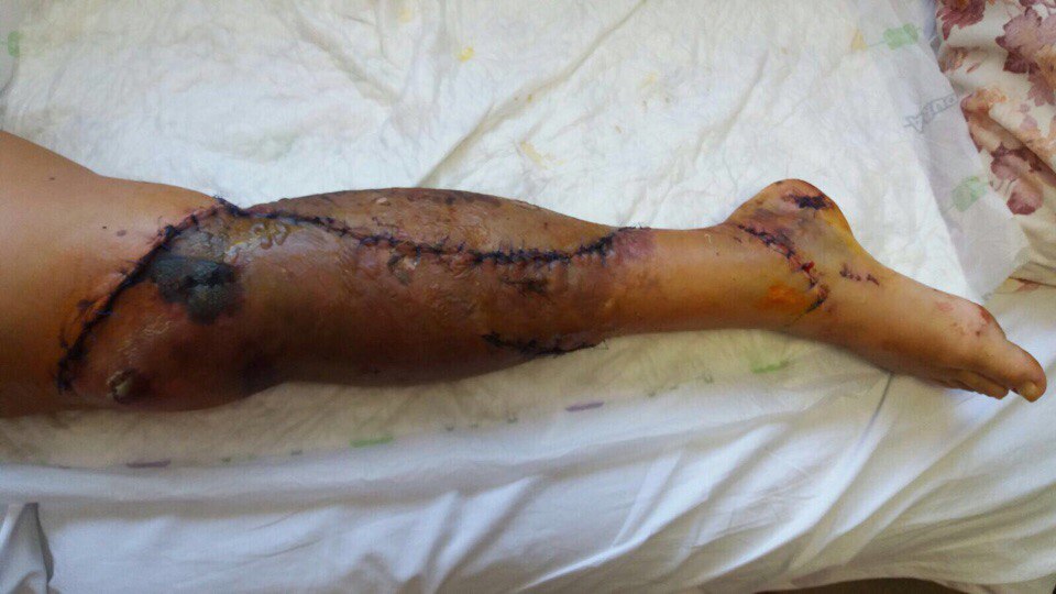 Екатеринбурженка, едва не лишившаяся ноги в страшной аварии в Анталии, ждет вторую операцию - Фото 4