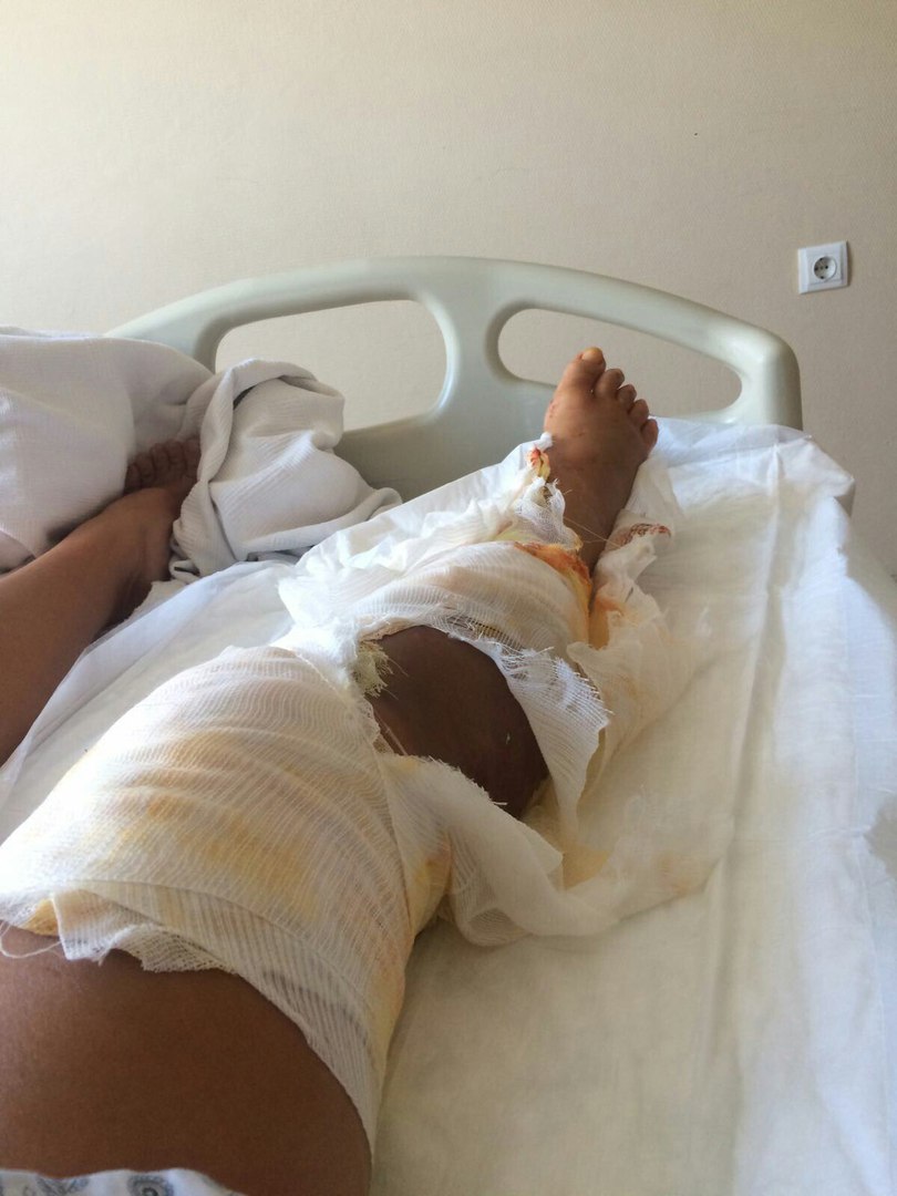 Екатеринбурженка, едва не лишившаяся ноги в страшной аварии в Анталии, ждет вторую операцию - Фото 5