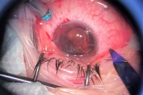 Екатеринбургские офтальмологи спасли глаз 10-летнему мальчику после глубокого ранения осколком петарды - Фото 1