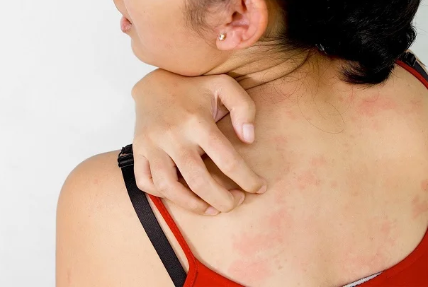 Медики рассказали, как успешно бороться с псориазом - Фото 1