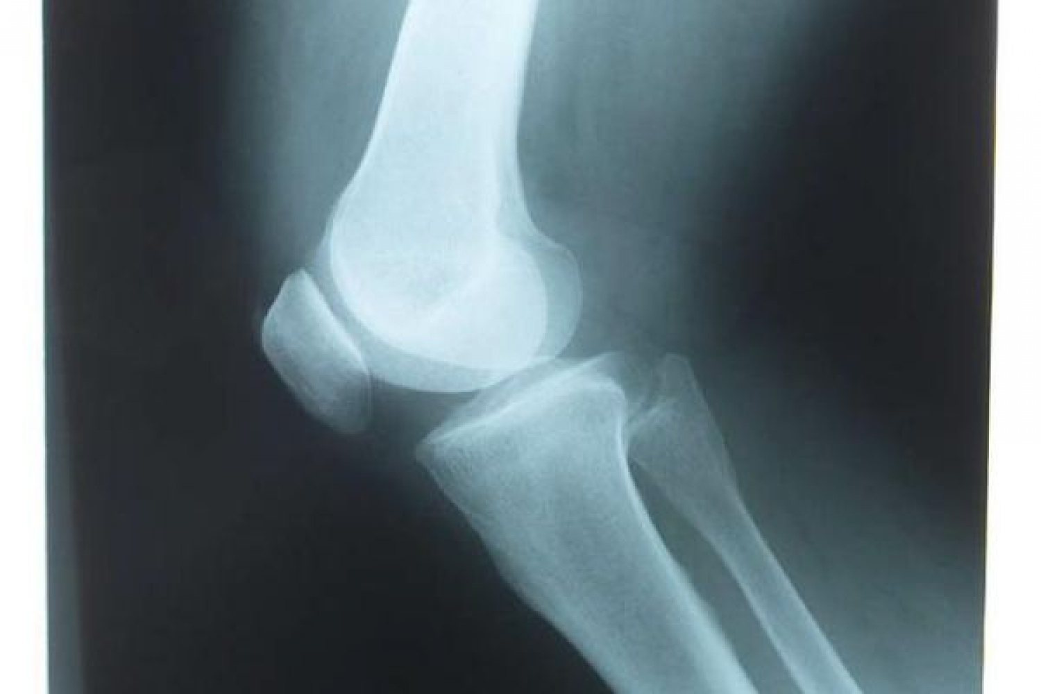 Трещина в коленной. Перелом надколенника рентген. Перелом коленного сустава рентген. Рентген колена перелом надколенника.