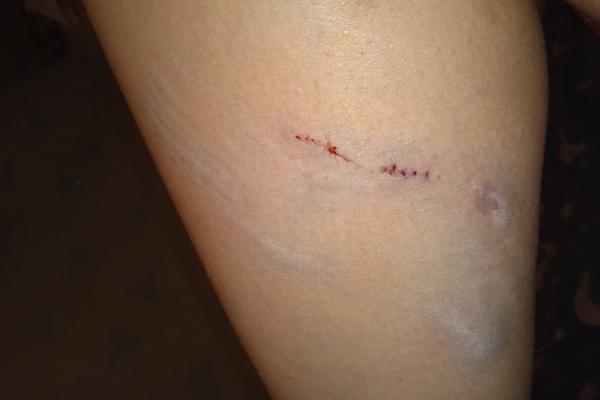 Беременную жительницу Серова искусали бродячие собаки