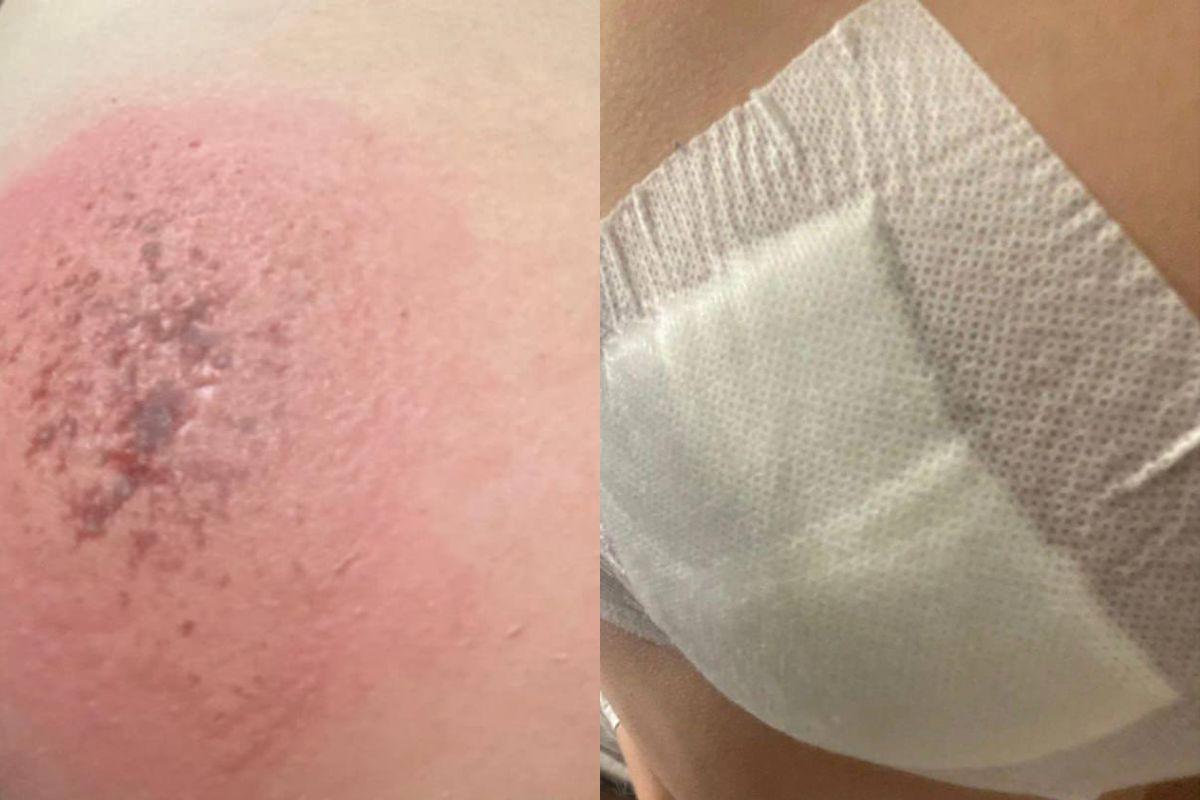 Жительница Екатеринбурга получила ожог ягодицы во время поездки в автобусе №24 - Фото 1