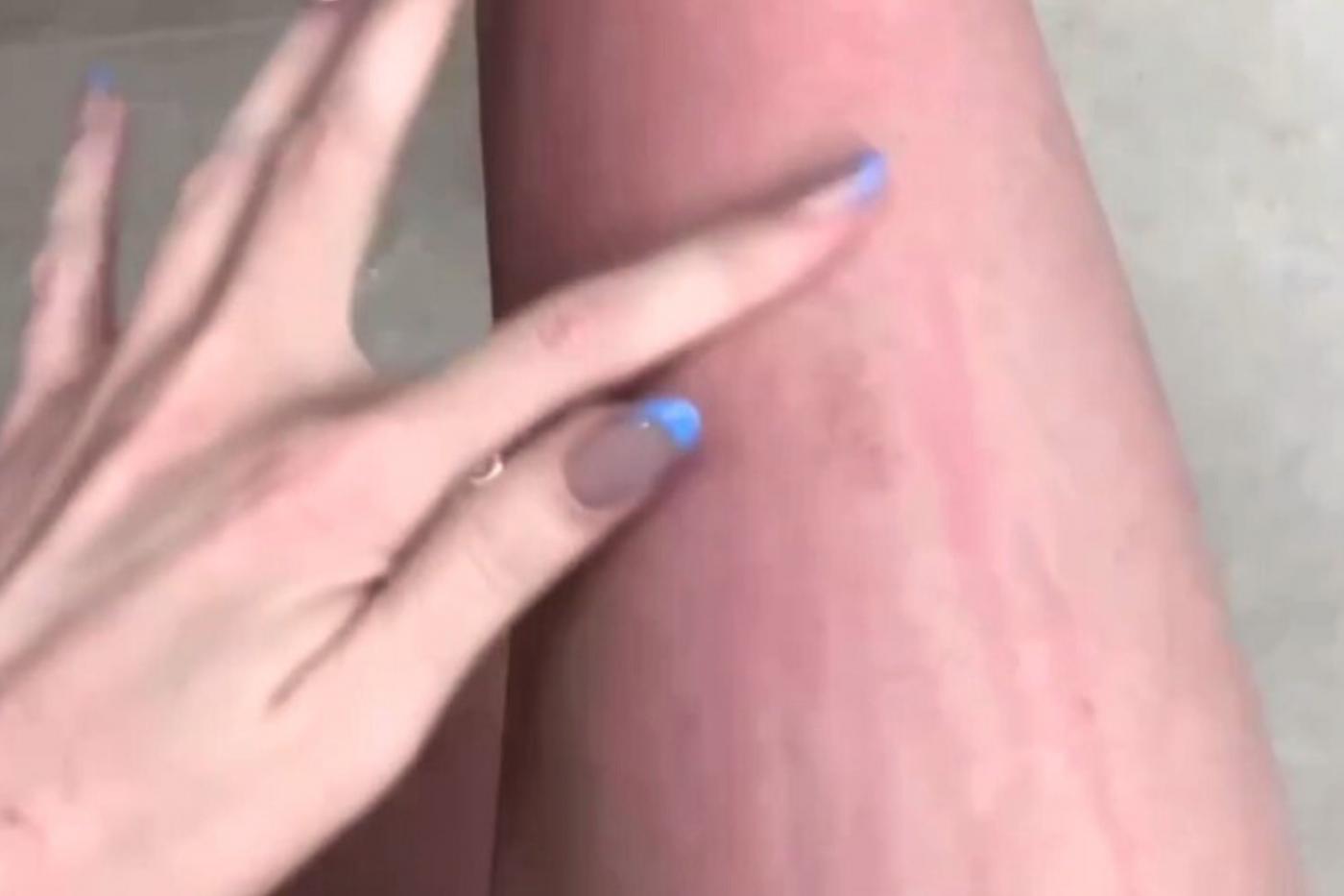 Жительница Екатеринбурга покрылась сыпью после посещения новых терм «Юга» - Фото 1