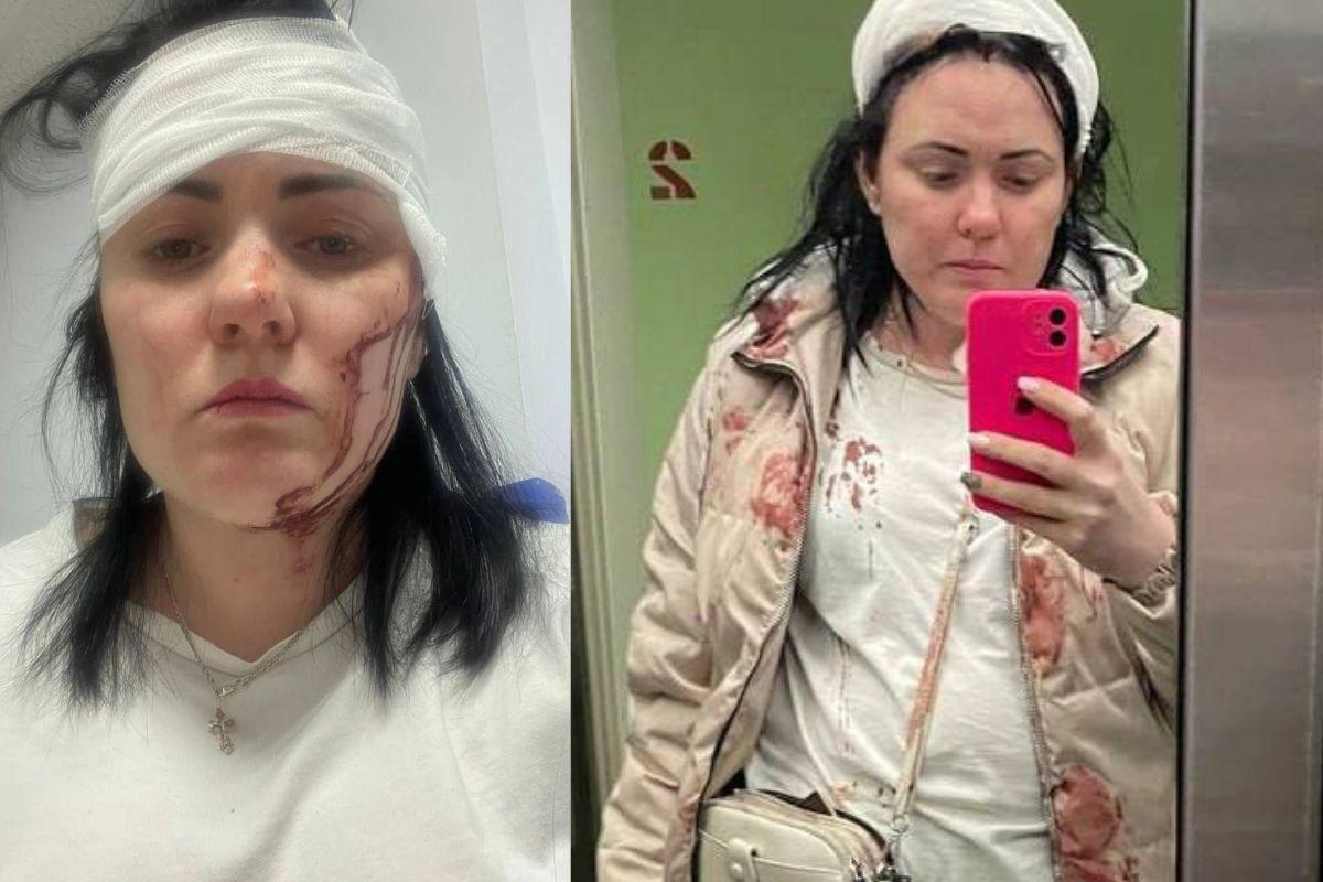 В Екатеринбурге девушке рассек голову упавший с многоэтажки кусок штукатурки - Фото 1