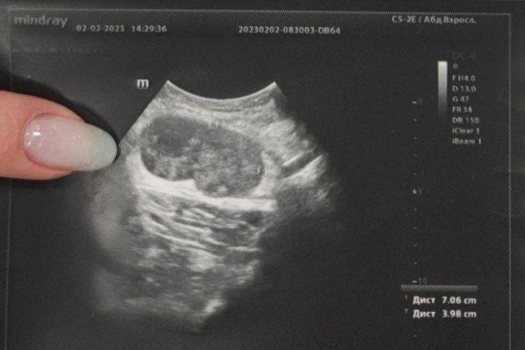 «Это большая редкость». Врачи выявили у екатеринбуржца метастаз, но без самой опухоли - Фото 1