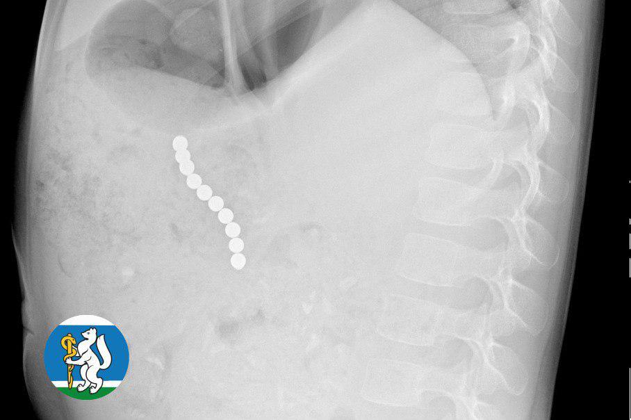 В Екатеринбурге хирурги спасли 5-летнюю девочку, которая проглотила 10 магнитных шариков - Фото 1