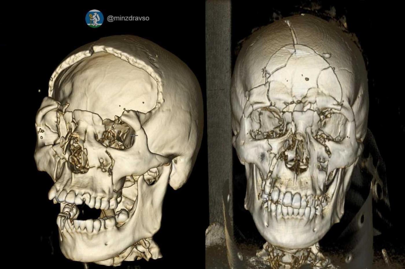 В Нижнем Тагиле врачи спасли 25-летнего парня с раздробленным в ДТП черепом - Фото 1