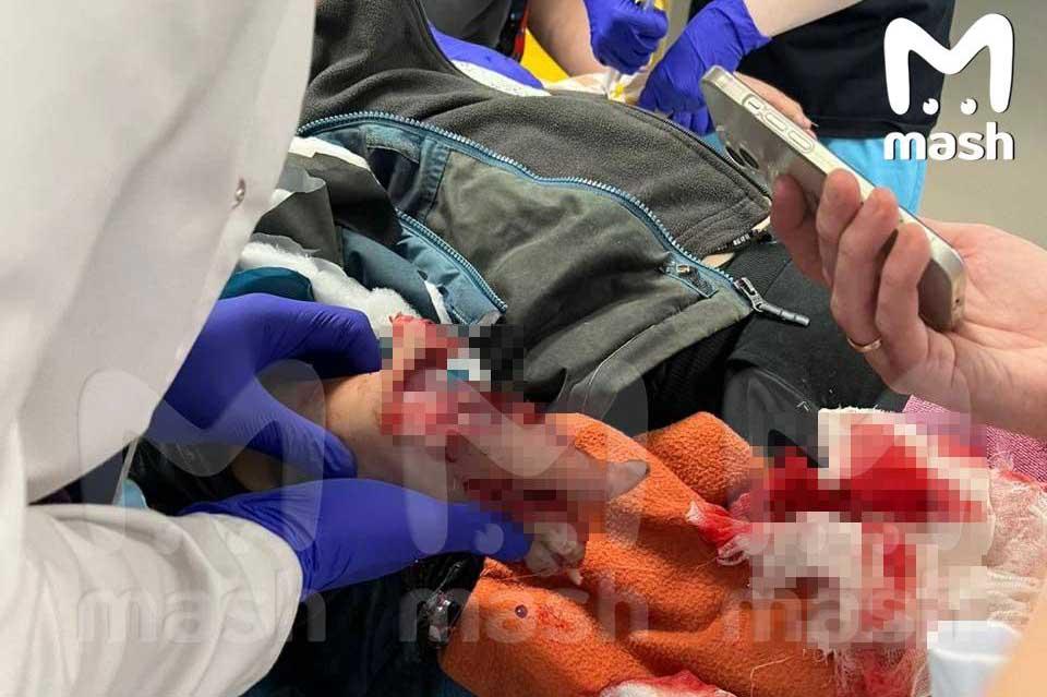В Красногорске 9-летний мальчик поднял деньги с земли и лишился нескольких пальцев на руке - Фото 1