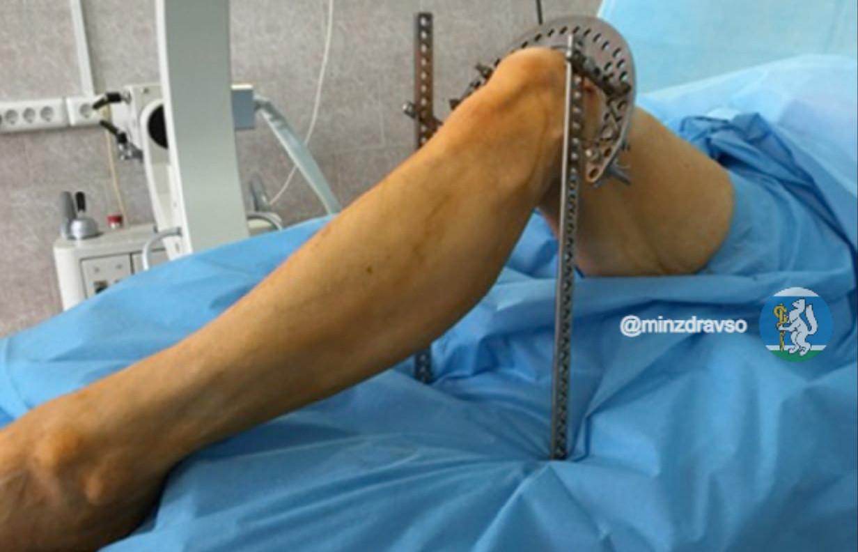 В Екатеринбурге учёные разработали уникальную технологию лечения сложных переломов - Фото 1