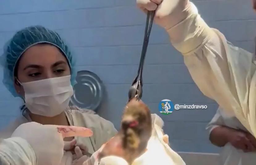 Полкило волос проглотила 25-летняя екатеринбурженка и чуть не умерла - Фото 1