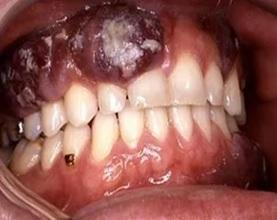 Воспаление, стоматит и рак. Горздрав рассказал, чем чревато употребление снюса. ФОТО 18+ - Фото 2