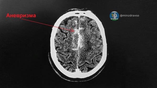 Врачи спасли 67-летнего екатеринбуржца от последствий «взрыва» в голове, когда он был за рулем - Фото 2