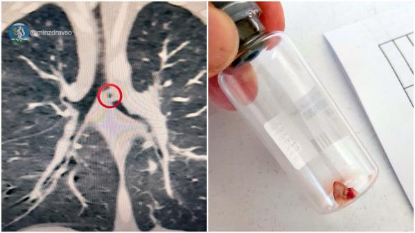 В Свердловской области годовалый ребенок чуть не задохнулся, проглотив кусок глины от печки - Фото 2