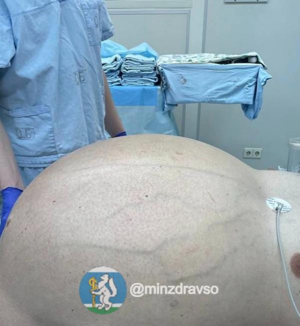 Свердловские онкологи удалили у пациента опухоль весом более 60 кг. ВИДЕО - Фото 2