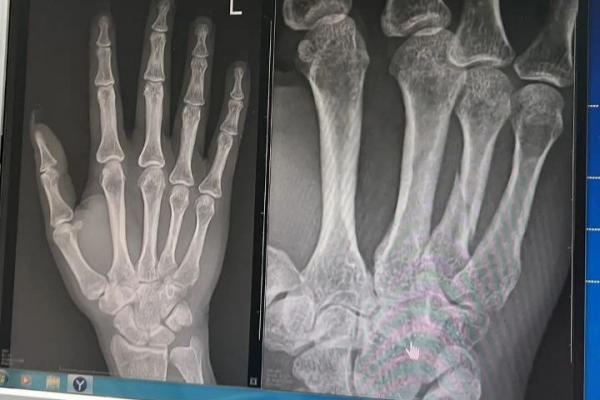 Жительница Екатеринбурга сломала руку во время заезда в картинг-центре и осталась без работы - Фото 3