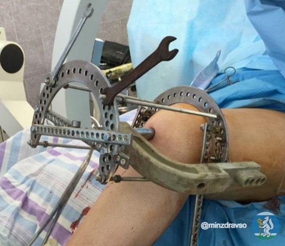 В Екатеринбурге учёные разработали уникальную технологию лечения сложных переломов - Фото 2