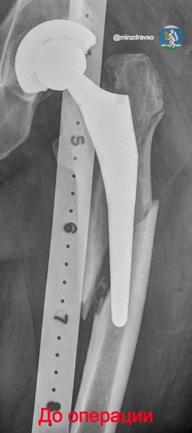 В Екатеринбурге учёные разработали уникальную технологию лечения сложных переломов - Фото 3