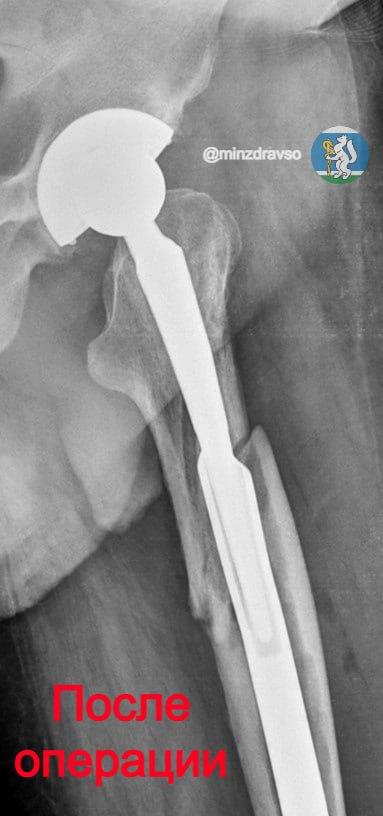 В Екатеринбурге учёные разработали уникальную технологию лечения сложных переломов - Фото 4