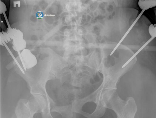 Врачи вернули к жизни екатеринбурженку, которую переехала машина - Фото 2